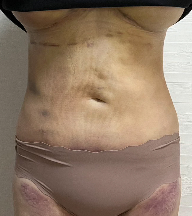 お腹の脂肪吸引