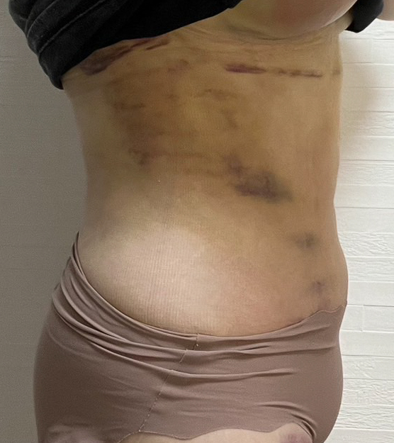 お腹の脂肪吸引