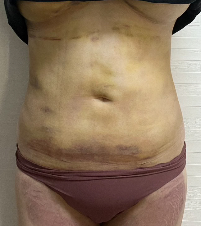 お腹の脂肪吸引