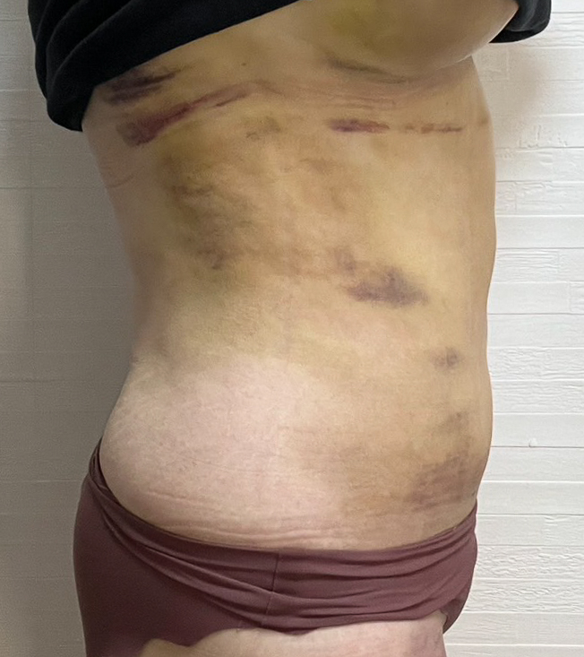 お腹の脂肪吸引