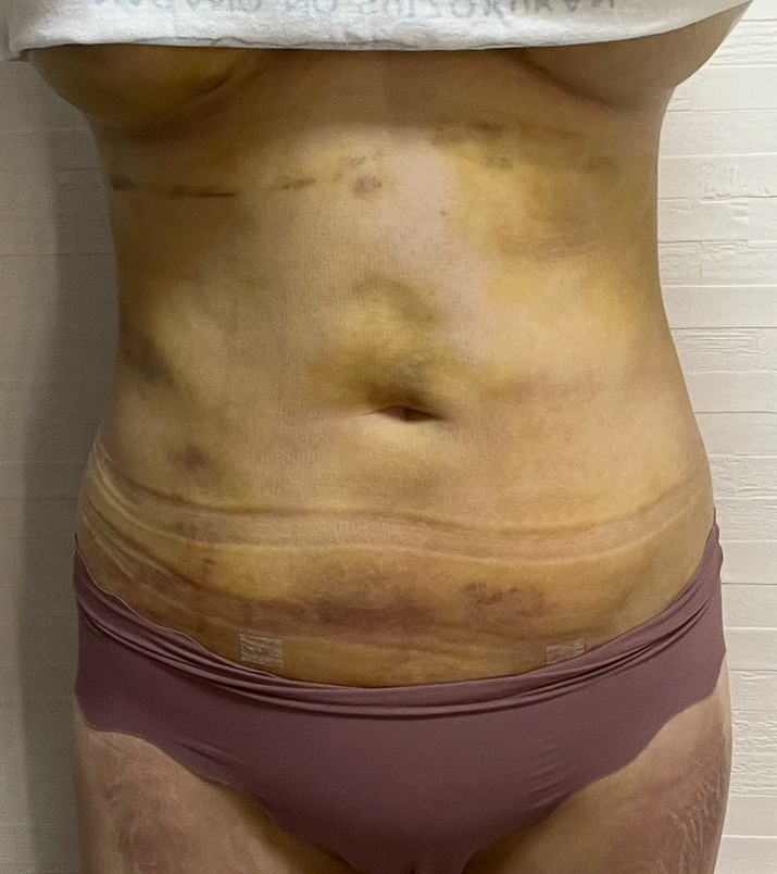 お腹の脂肪吸引