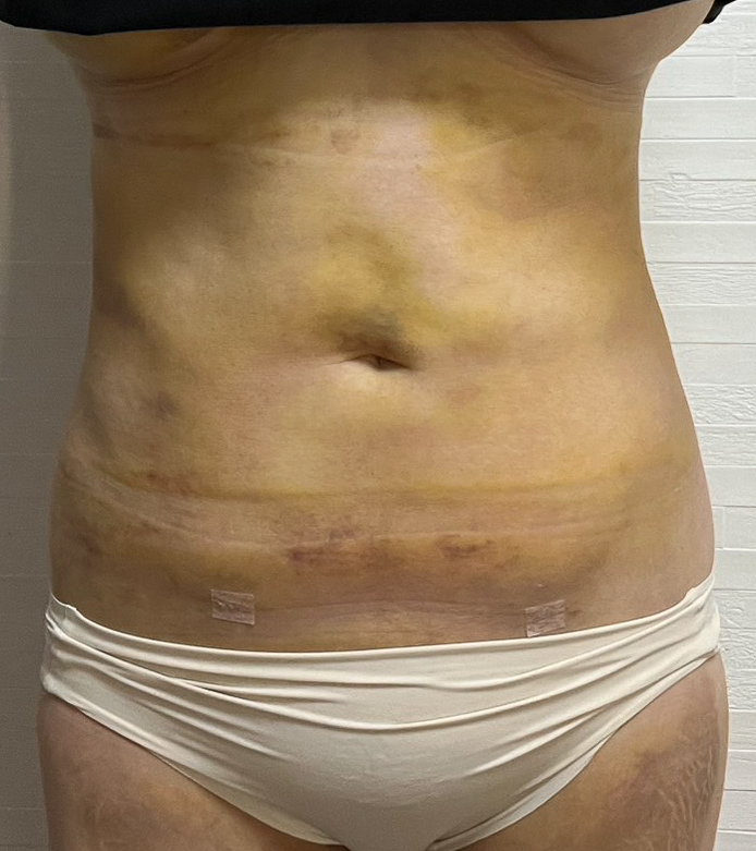 お腹の脂肪吸引