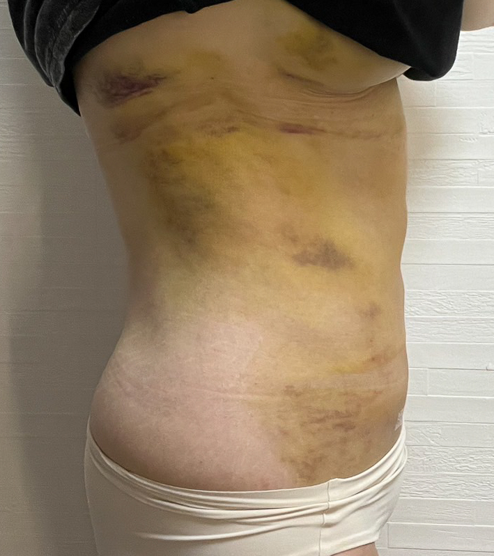 お腹の脂肪吸引