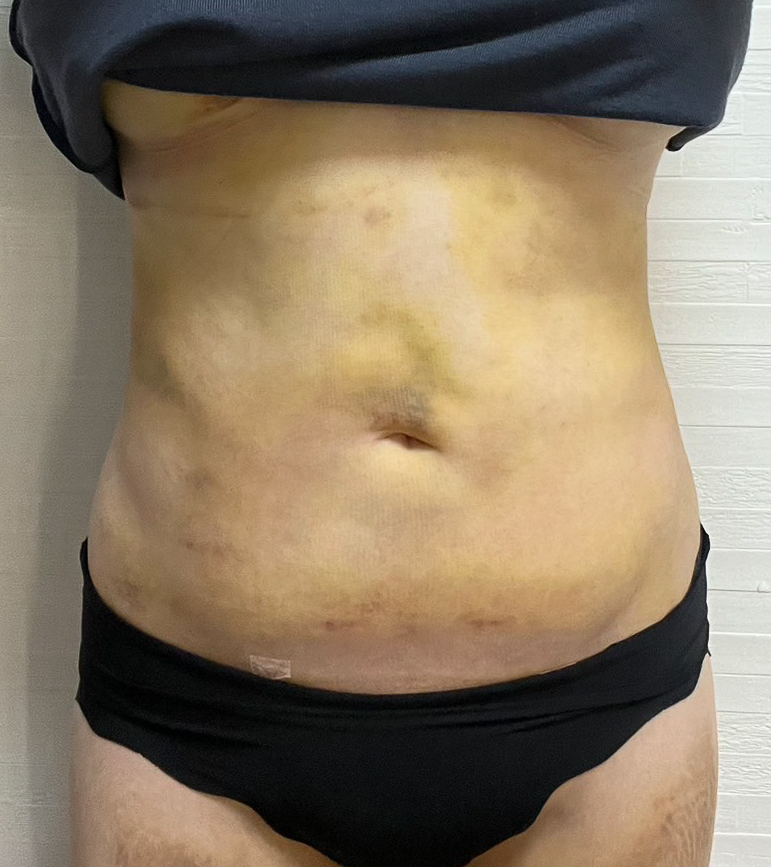 お腹の脂肪吸引