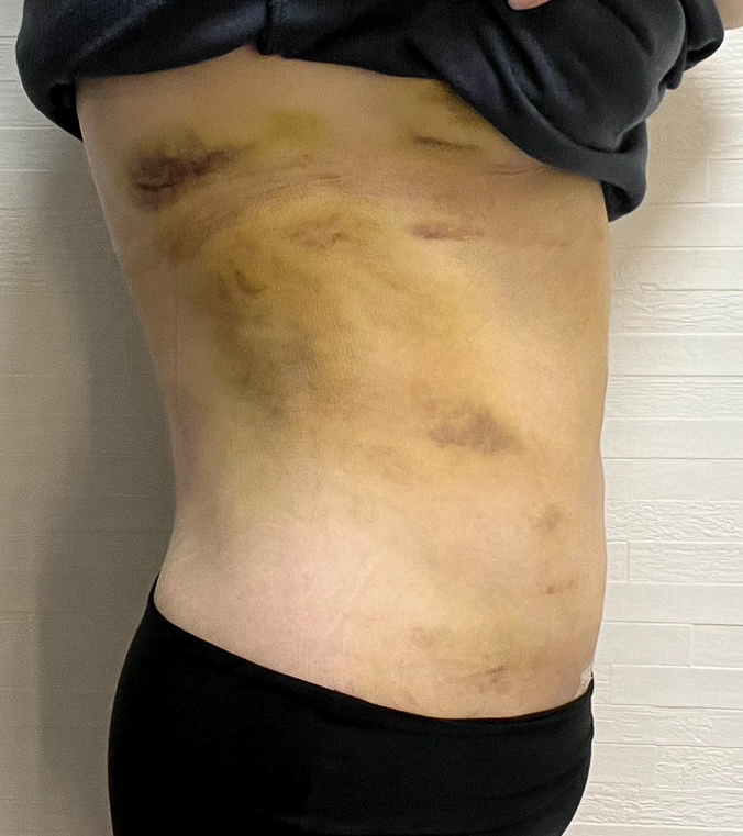 お腹の脂肪吸引