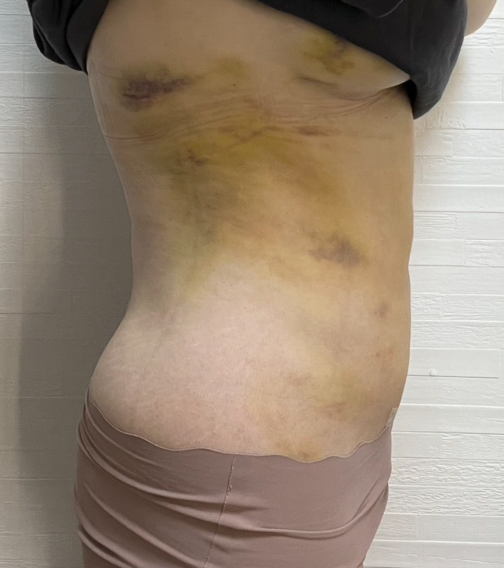 お腹の脂肪吸引