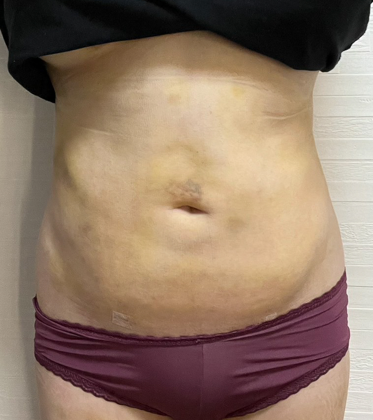 お腹の脂肪吸引