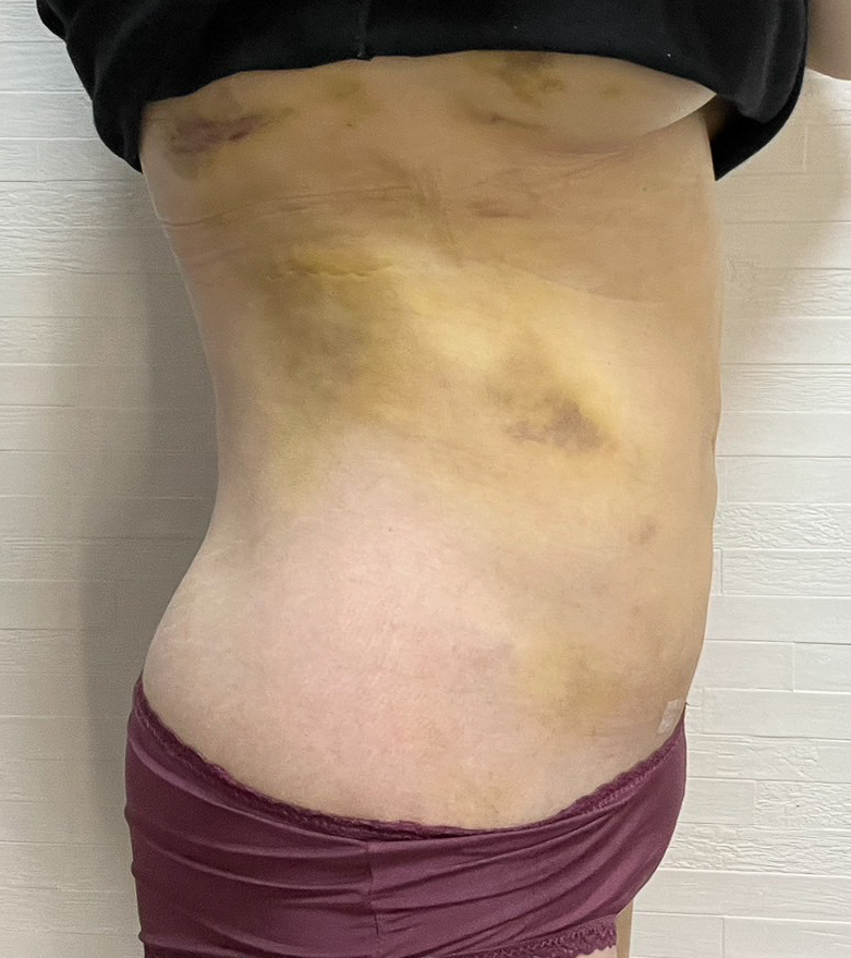 お腹の脂肪吸引