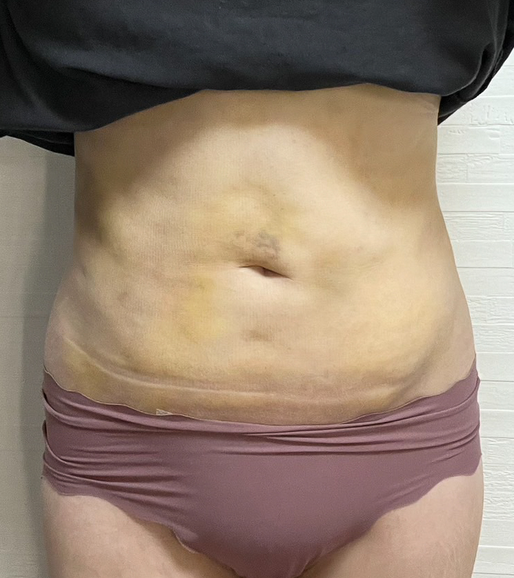 お腹の脂肪吸引