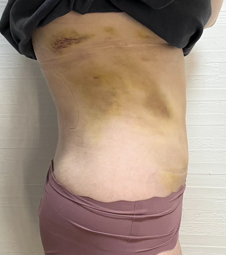 お腹の脂肪吸引