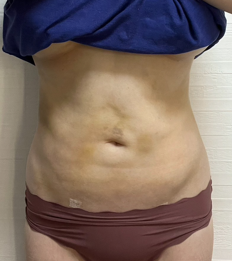 お腹の脂肪吸引