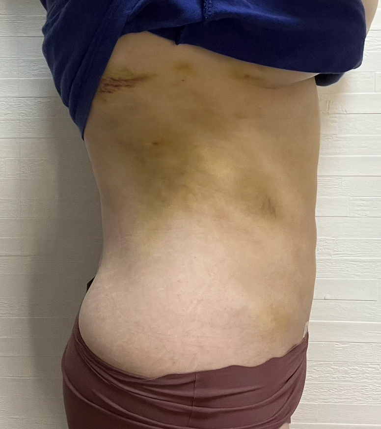 お腹の脂肪吸引