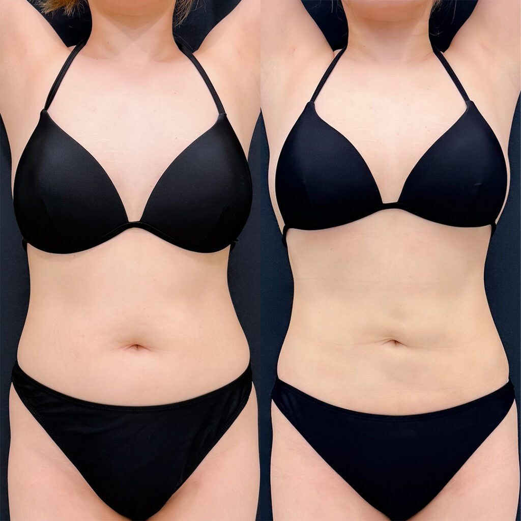 お腹の脂肪吸引