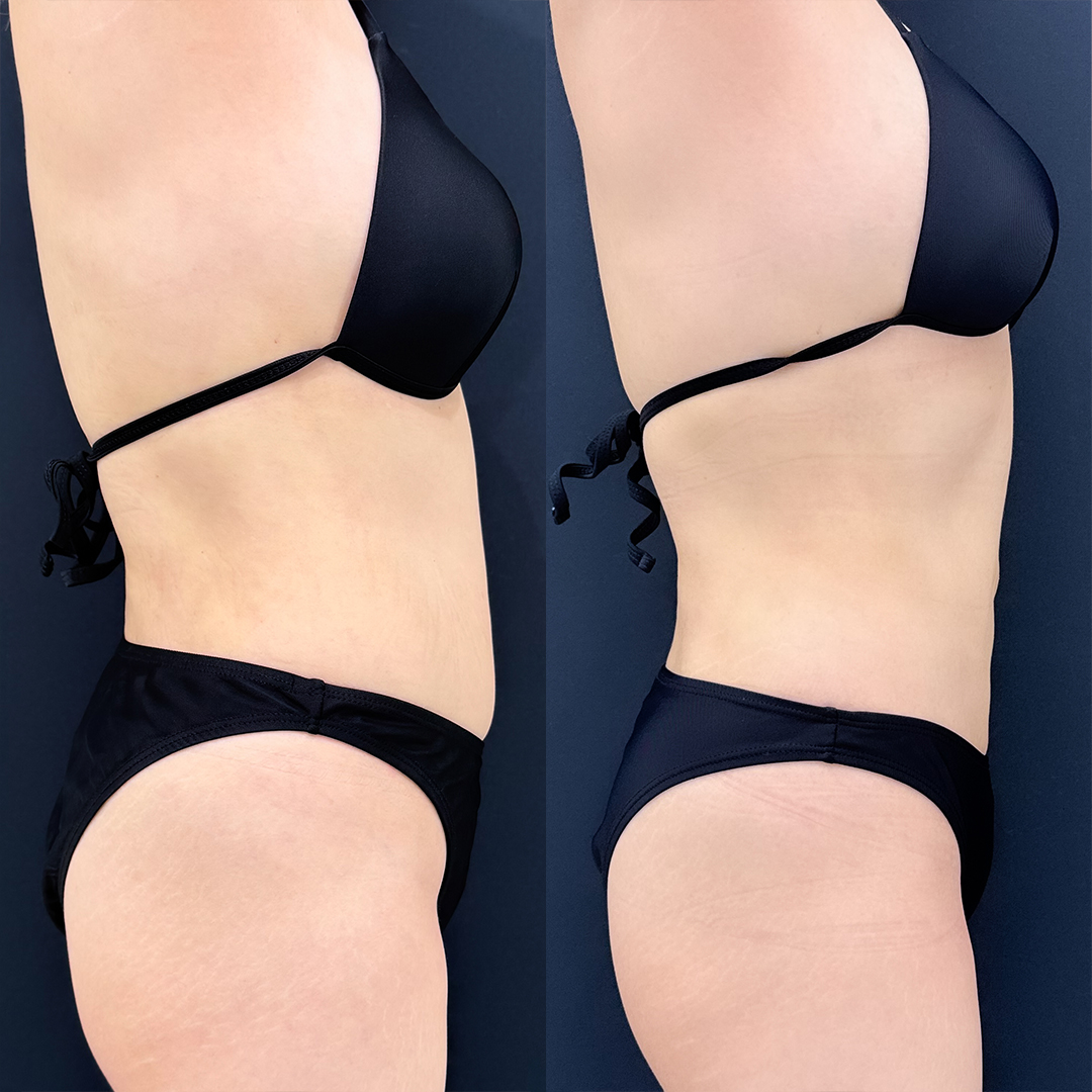 https://purelys-tokyo-clinic.com/wp/wp-content/uploads/2025/12/Before-and-After-abdominal-Liposuction_Case-No.212.jpg