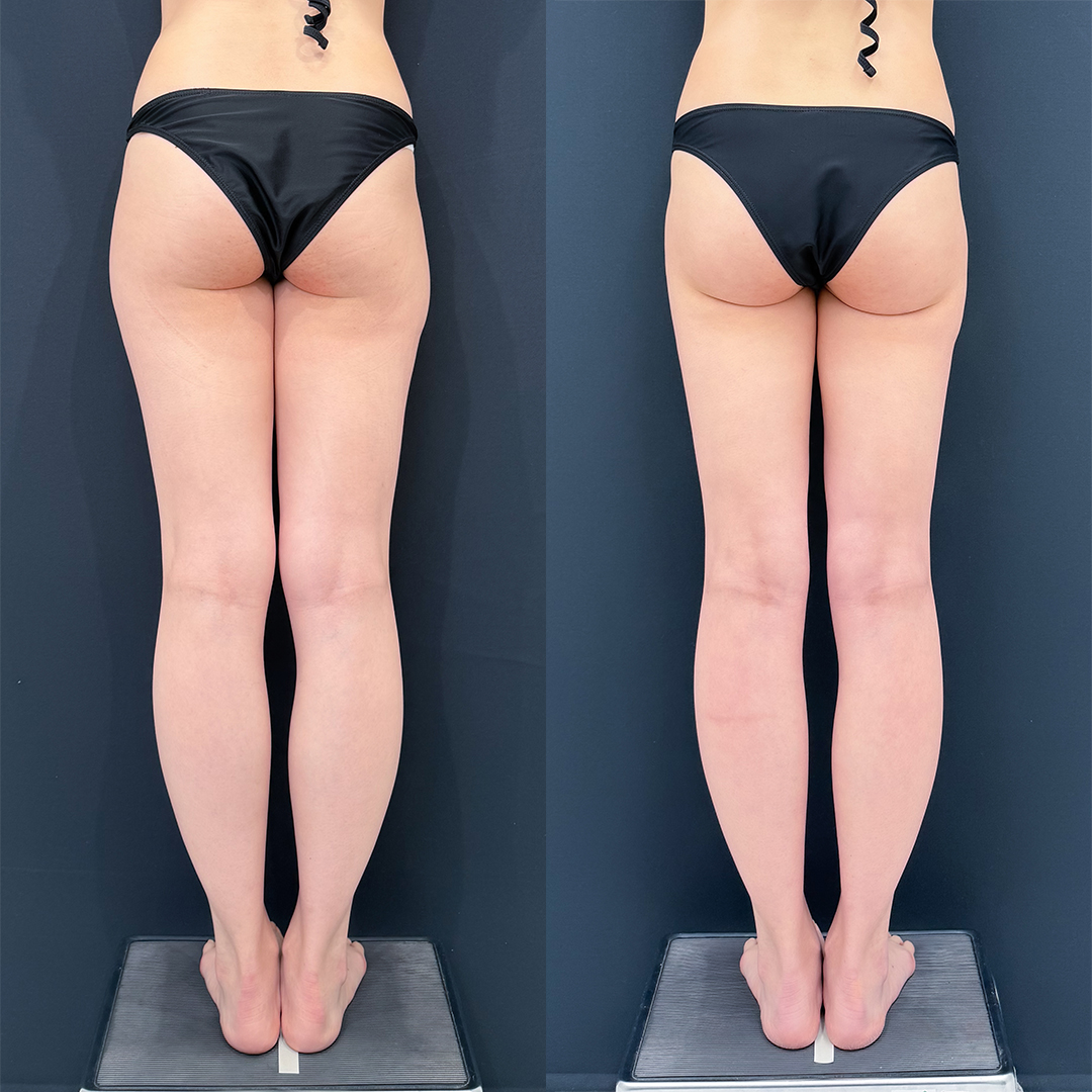 https://purelys-tokyo-clinic.com/wp/wp-content/uploads/2025/12/Liposuction_Case-No.264.jpg