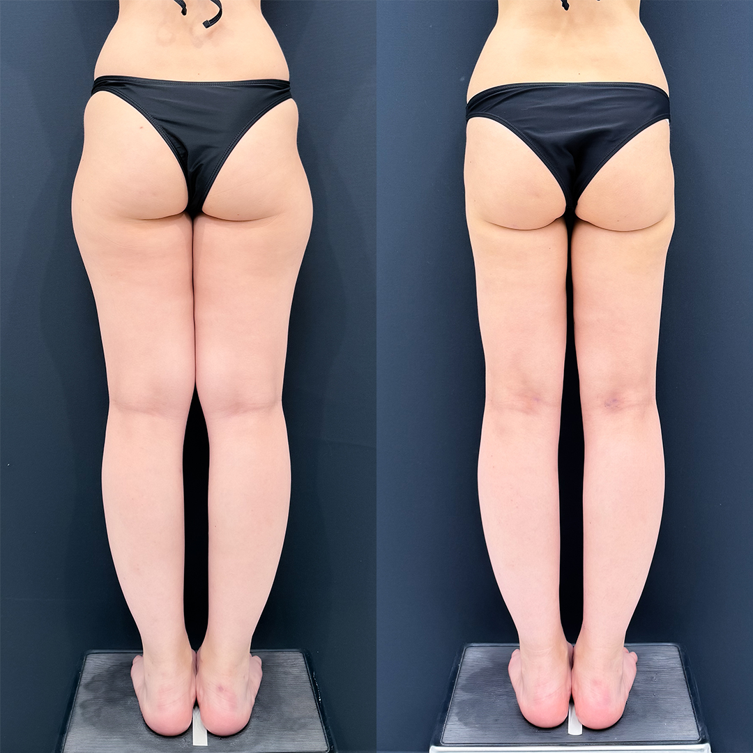 https://purelys-tokyo-clinic.com/wp/wp-content/uploads/2025/12/Liposuction_Case-No.315.jpg