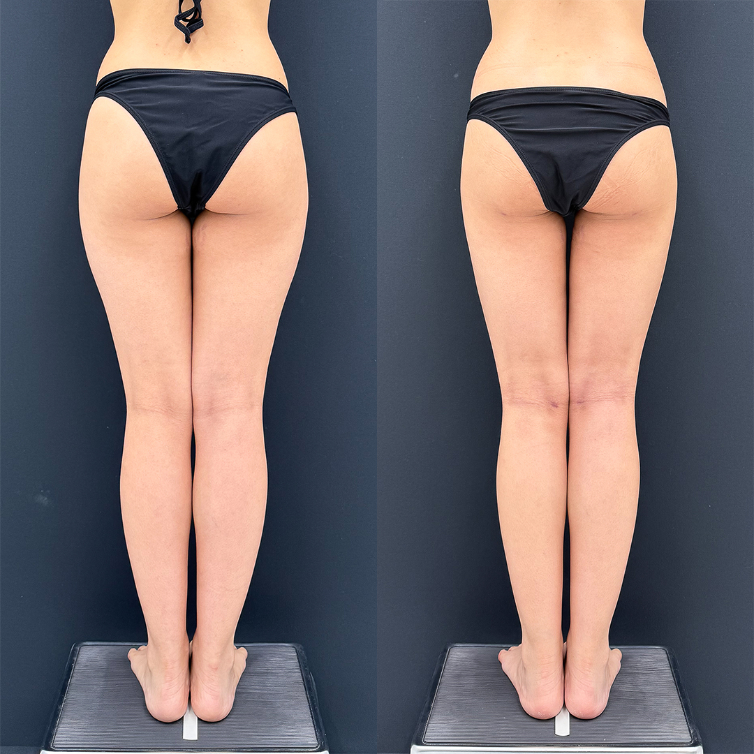 https://purelys-tokyo-clinic.com/wp/wp-content/uploads/2025/12/Liposuction_Case-No.347.jpg