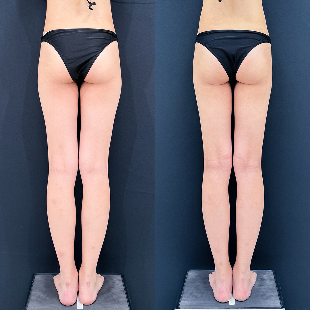 https://purelys-tokyo-clinic.com/wp/wp-content/uploads/2025/12/Liposuction_Case-No.377.jpg