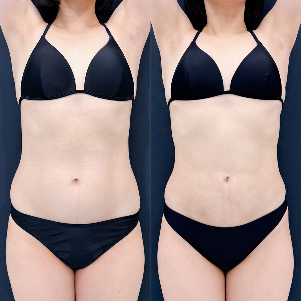 お腹の脂肪吸引