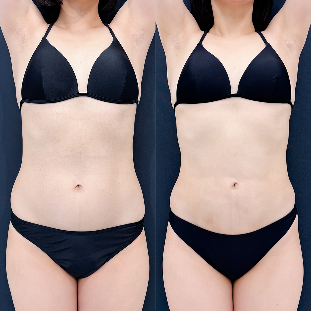 https://purelys-tokyo-clinic.com/wp/wp-content/uploads/2025/12/Liposuction_Case-No.379.jpg
