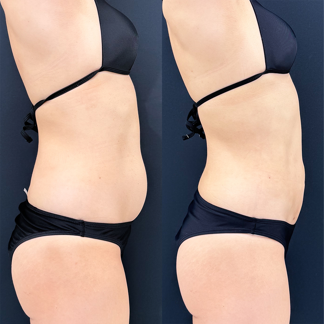 https://purelys-tokyo-clinic.com/wp/wp-content/uploads/2025/12/Liposuction_Case-No.380.jpg