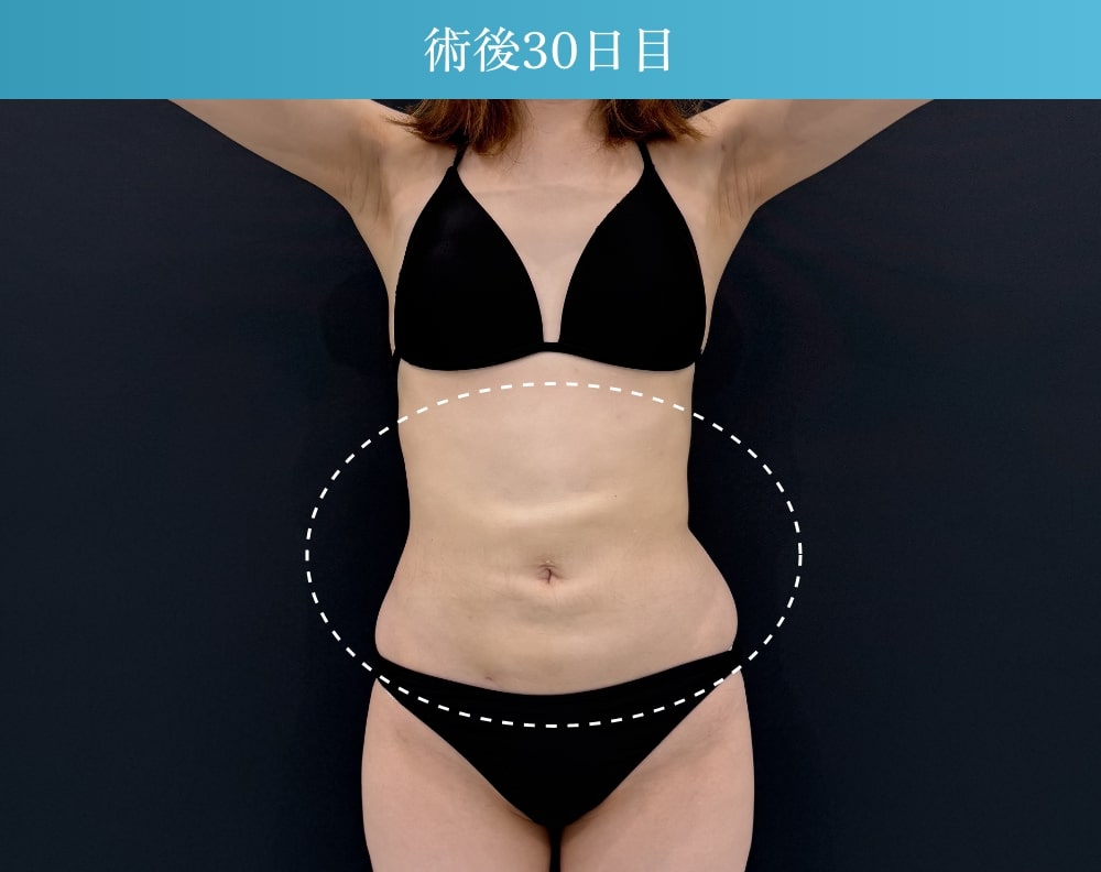 お腹の脂肪吸引の拘縮症例(施術後30日目)