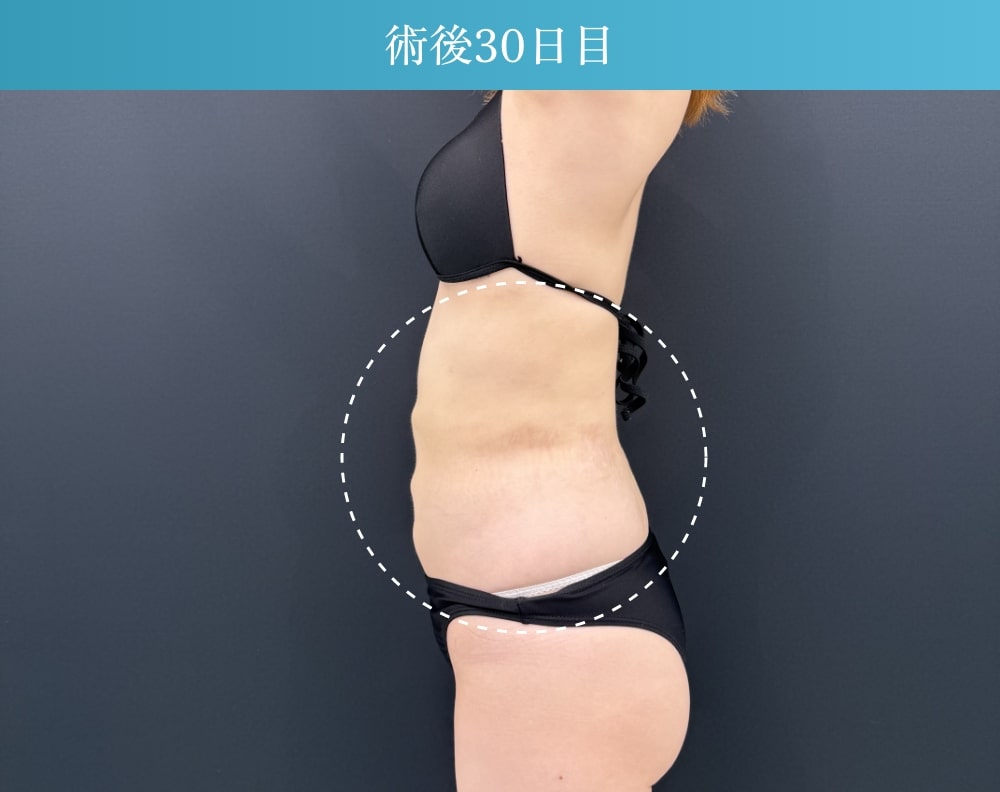 お腹の脂肪吸引の拘縮症例(施術後30日目)