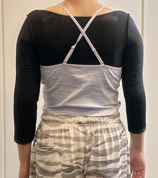 二の腕の脂肪吸引