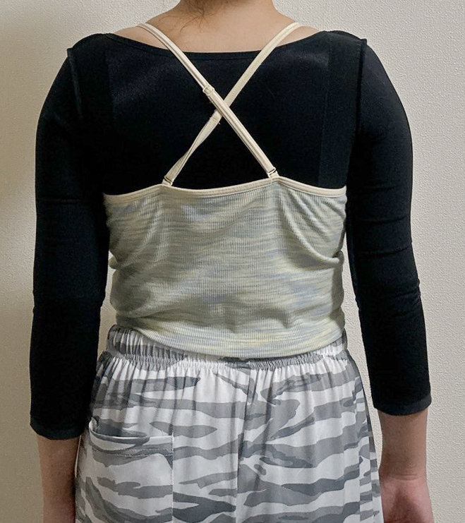 二の腕の脂肪吸引