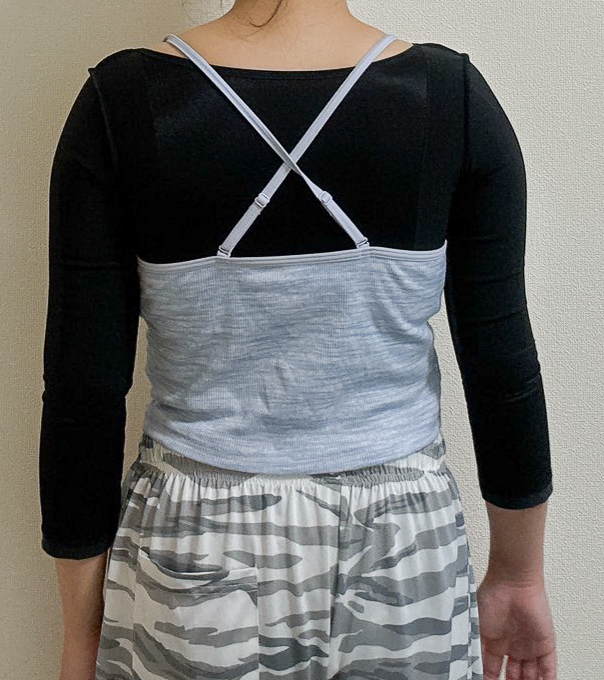 二の腕の脂肪吸引