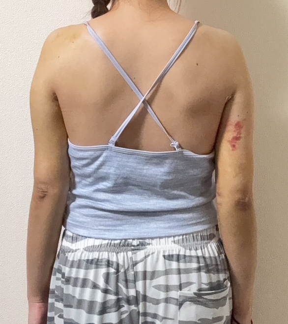 二の腕の脂肪吸引