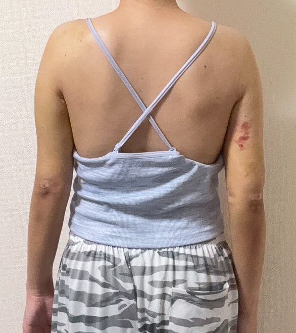 二の腕の脂肪吸引