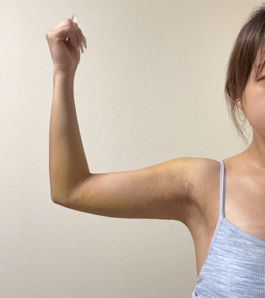 二の腕の脂肪吸引