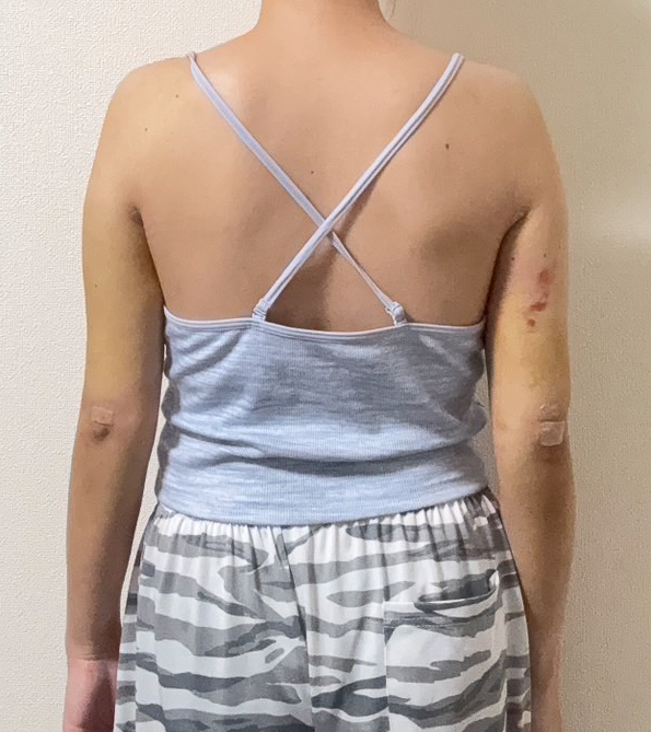 二の腕の脂肪吸引