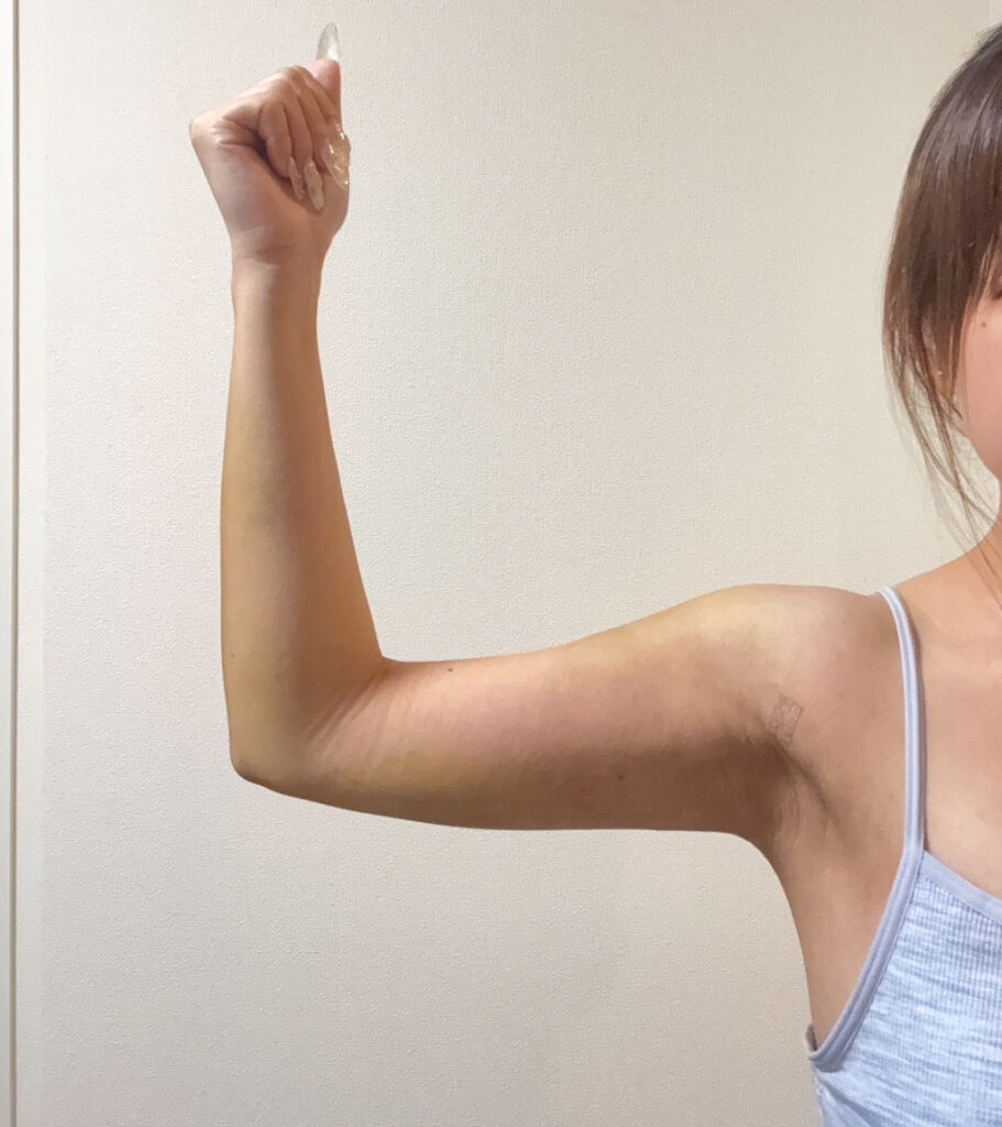 二の腕の脂肪吸引