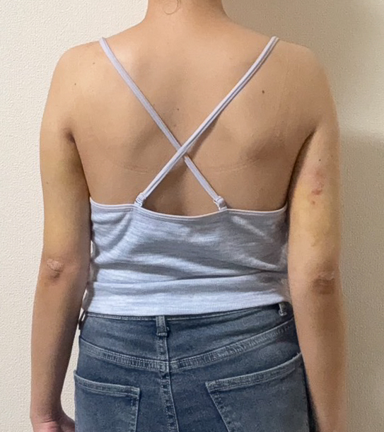 二の腕の脂肪吸引