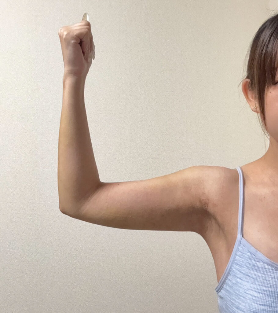 二の腕の脂肪吸引