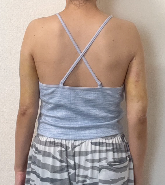 二の腕の脂肪吸引