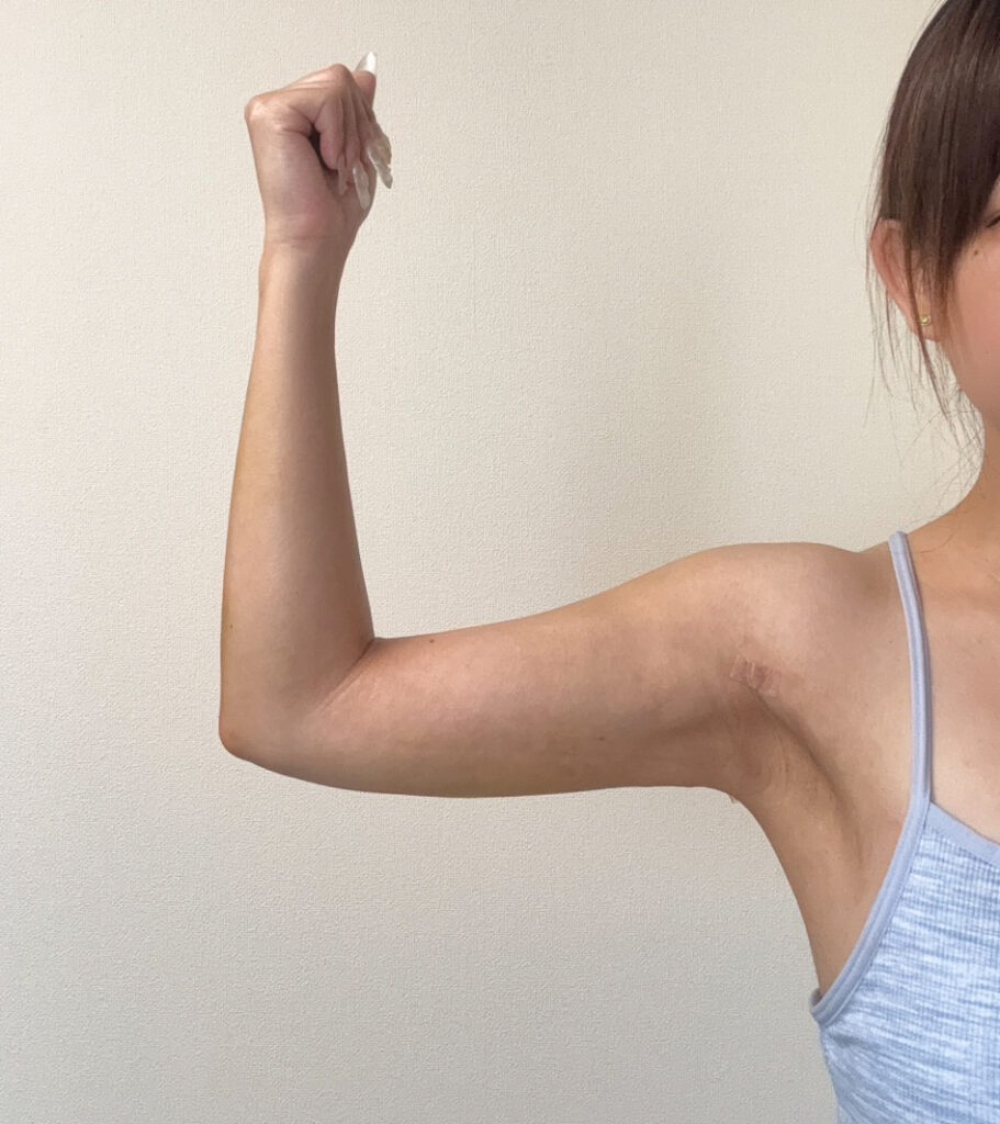 二の腕の脂肪吸引