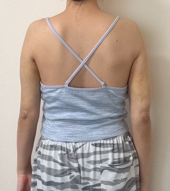 二の腕の脂肪吸引