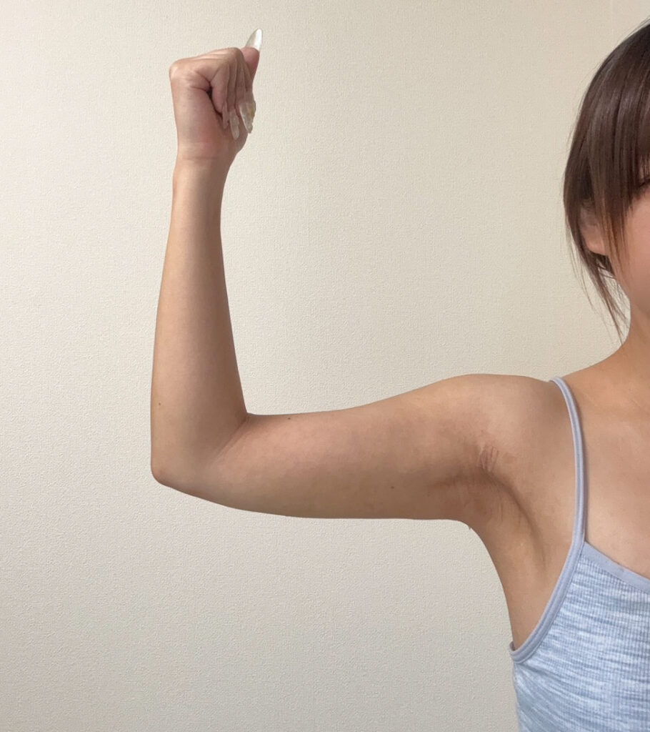 二の腕の脂肪吸引