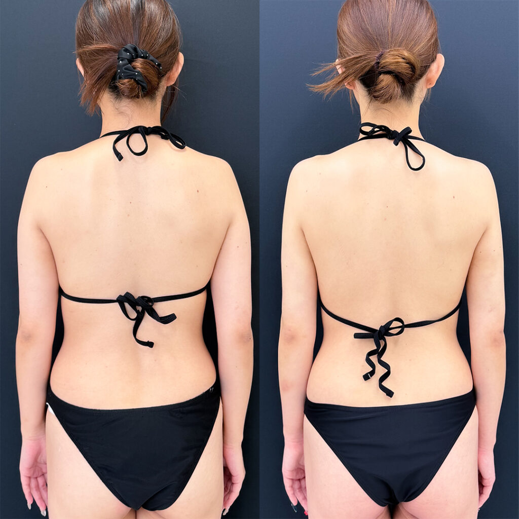 二の腕の脂肪吸引