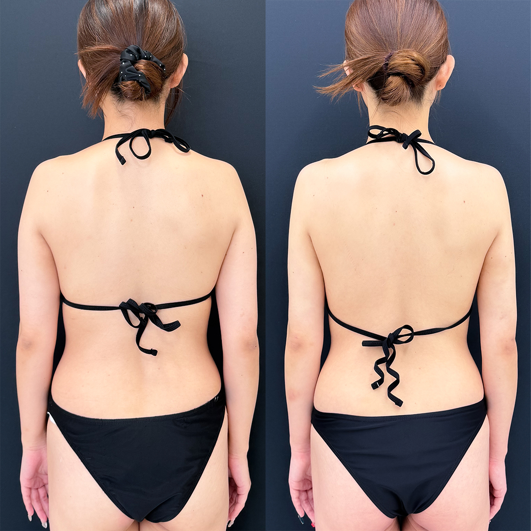 二の腕の脂肪吸引