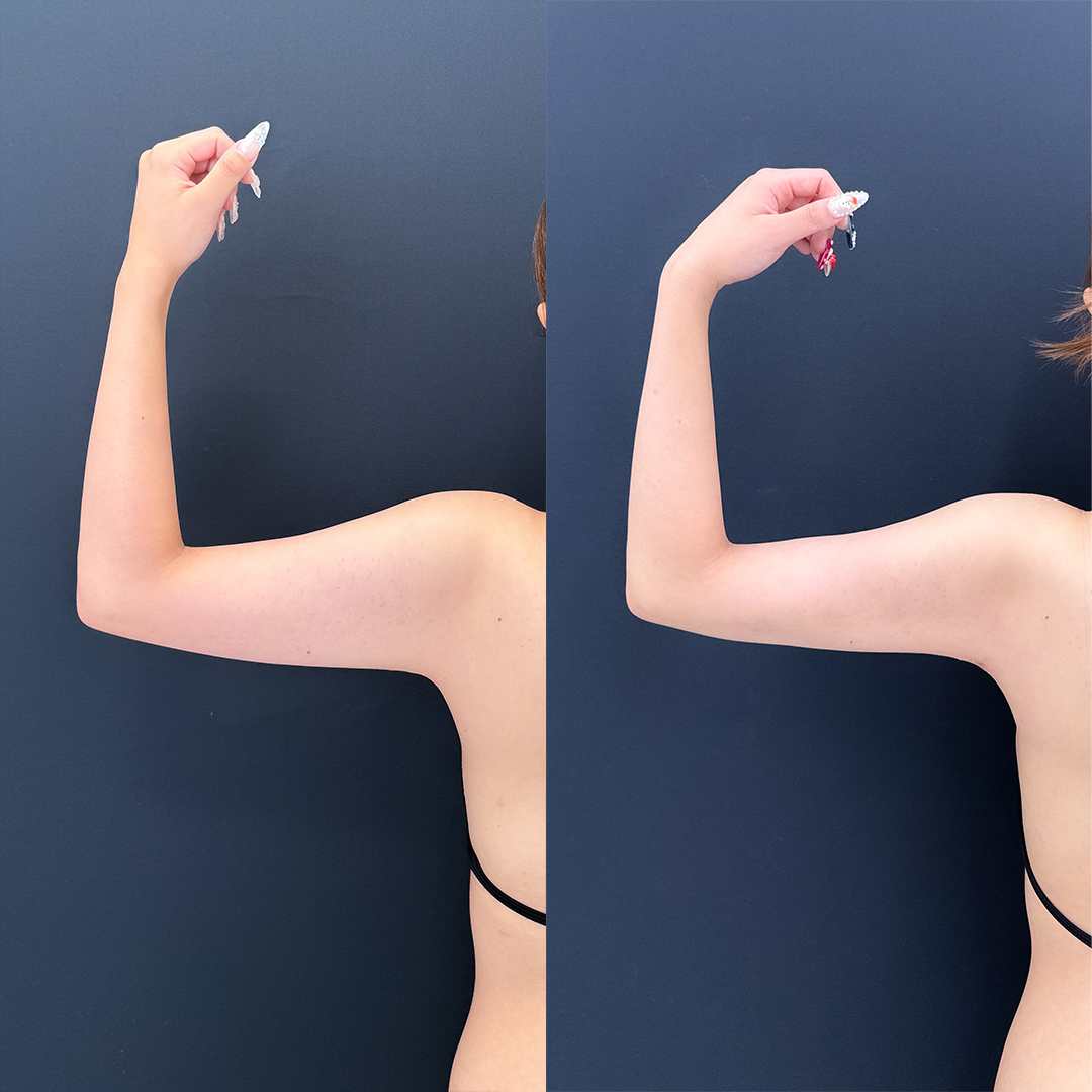 https://purelys-tokyo-clinic.com/wp/wp-content/uploads/2025/12/arm-Liposuction_Case-No.199.jpg
