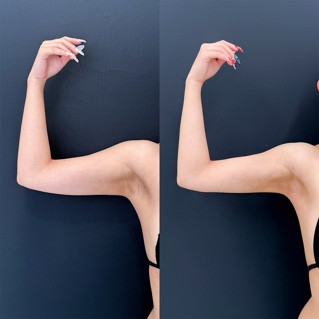 https://purelys-tokyo-clinic.com/wp/wp-content/uploads/2025/12/arm-Liposuction_Case-No.200.jpg