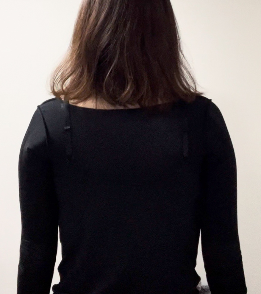 二の腕の脂肪吸引