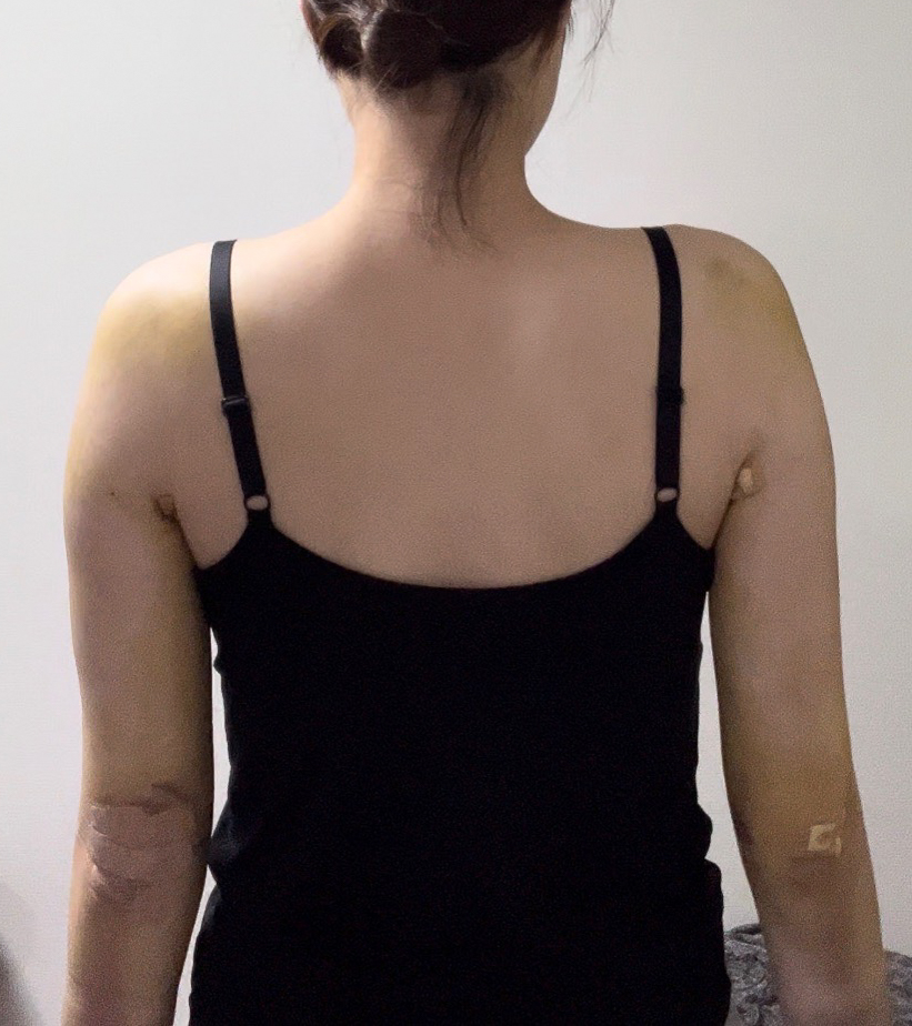 二の腕の脂肪吸引