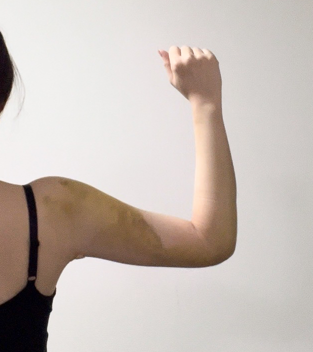 二の腕の脂肪吸引