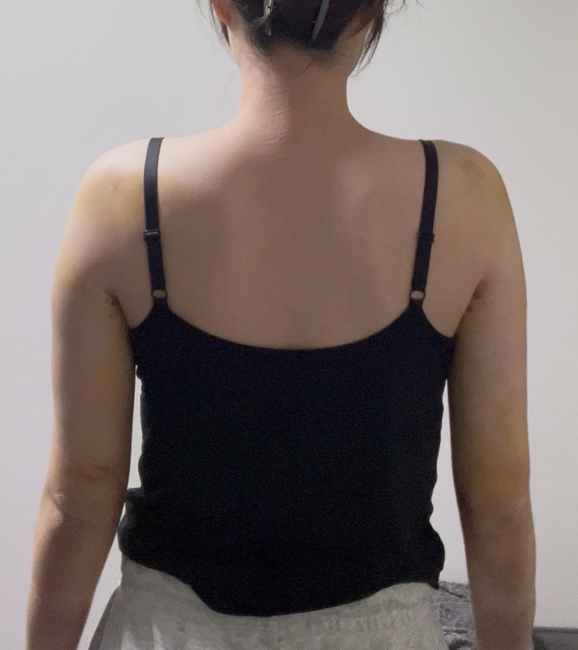 二の腕の脂肪吸引