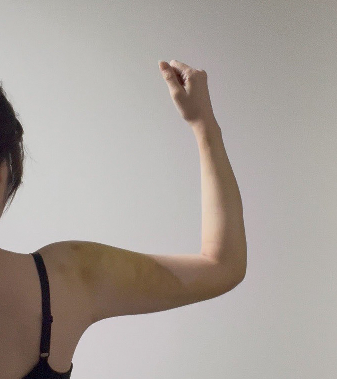 二の腕の脂肪吸引